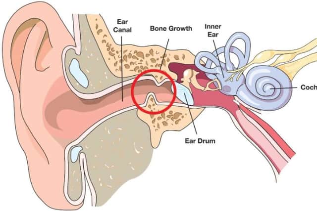 Protect your ears this summer! Wear swim ear plugs and prevent swimmer ...