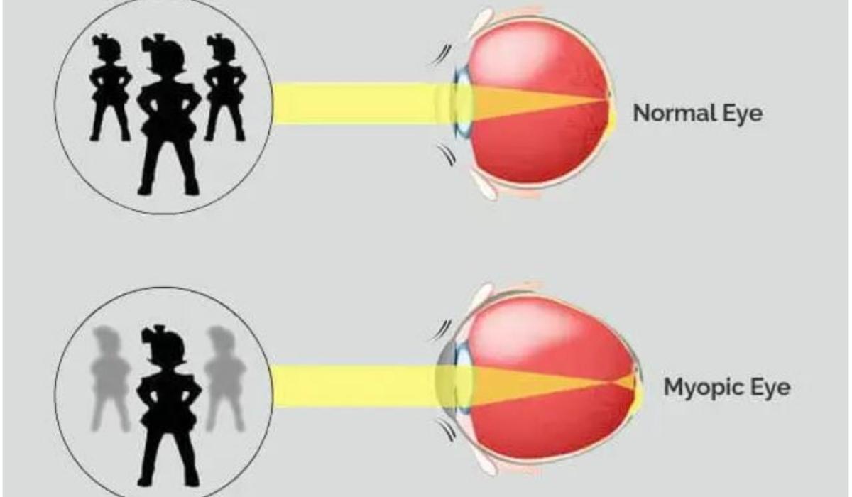 Stephen Olwell Opticians on myopia a growing global concern