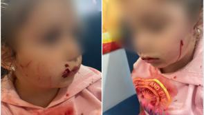 'We're in shock' - Horror cat attack in Ballymahon leaves 3 year-old Longford girl scarred